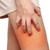 Get to Know If Rashes Can Be Treated Optimally with Vaseline? Primary points to consider!!